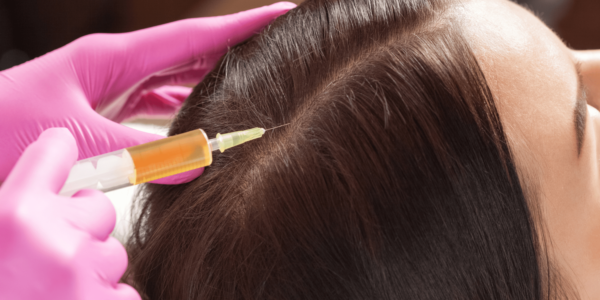 Growth Factor Concentrate (GFC) Treatment for Hair Loss